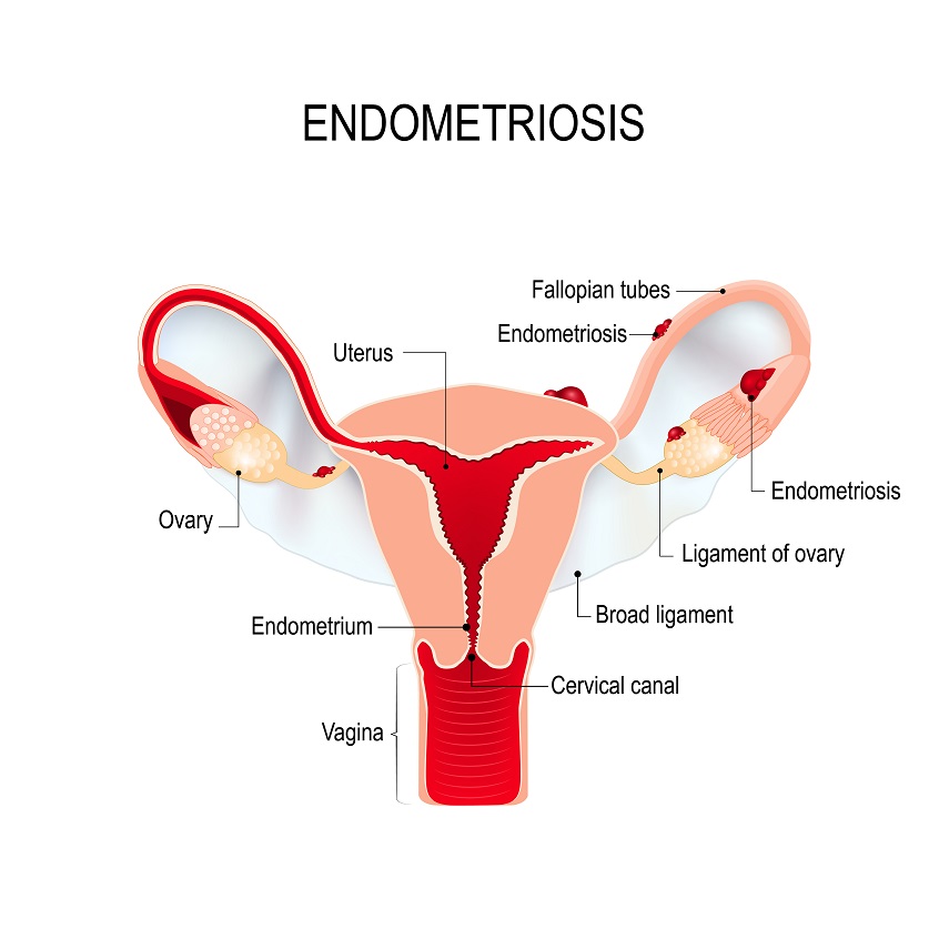 Endometriosis and Antioxidant Therapies